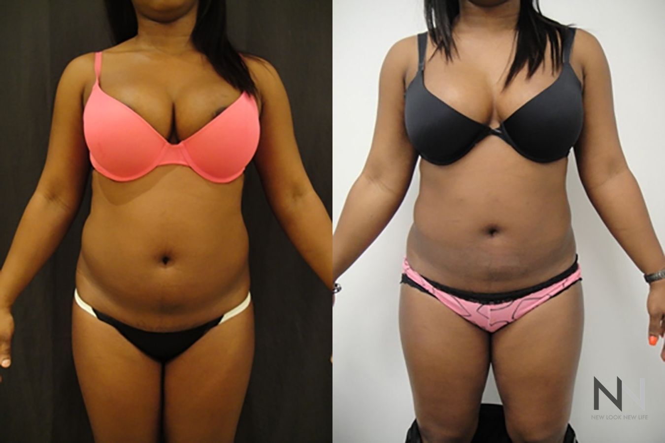 Liposuction 360 showing improved waistline definition
