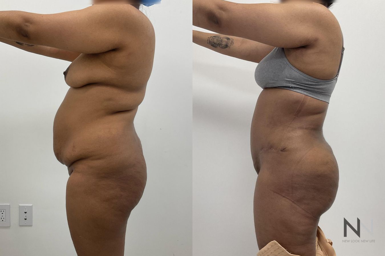 Before and after mommy makeover six months results - Angle 3