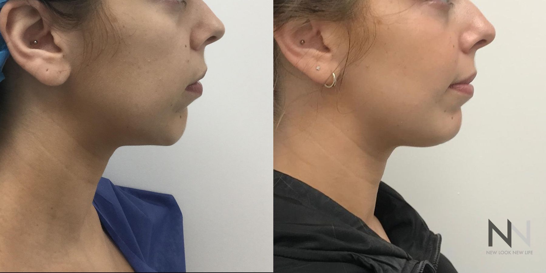 Before and after chin augmentation six months results