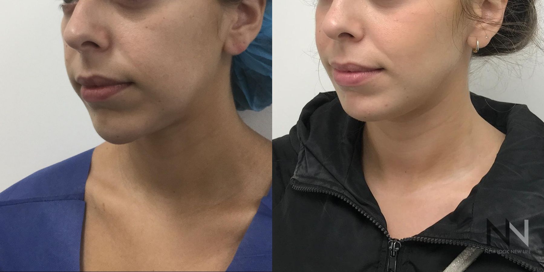 Before and after chin augmentation six months results - Angle 3