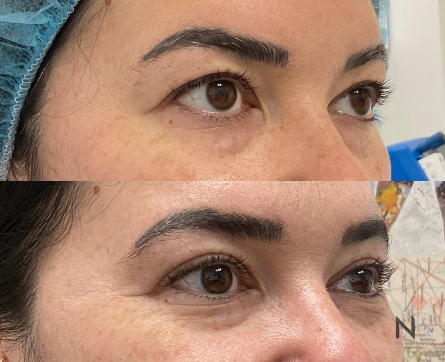 Before and after upper blepharoplasty three months results - Angle 2