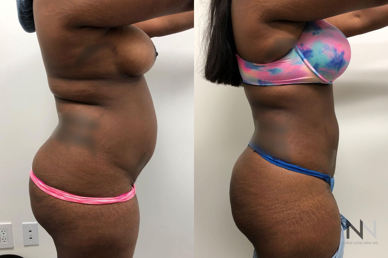 Before and after TICKLE liposuction six months results - Angle 3
