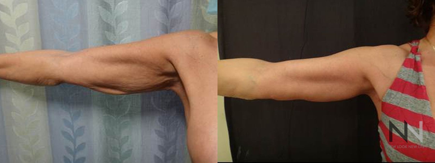 Before and after arm lift six months results
