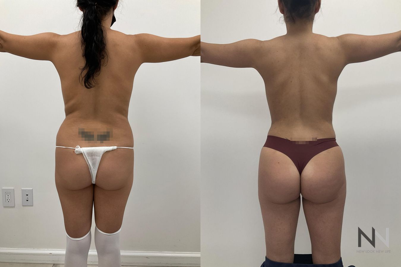 Before and after BBL and liposuction six months results