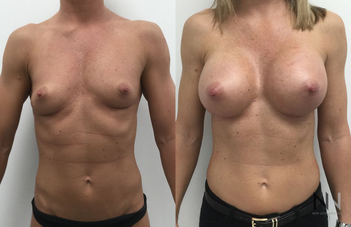 Breast implants showing increased volume and projection