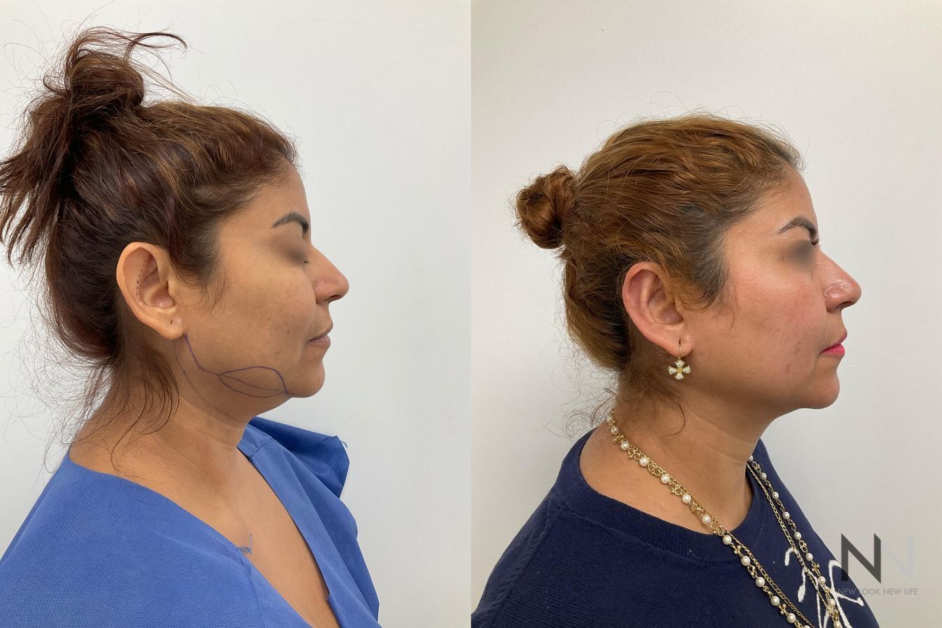 Jawline contour improvement after chin liposuction