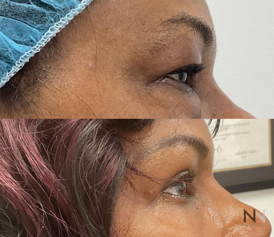 Before and after upper and lower blepharoplasty three months results - Angle 3