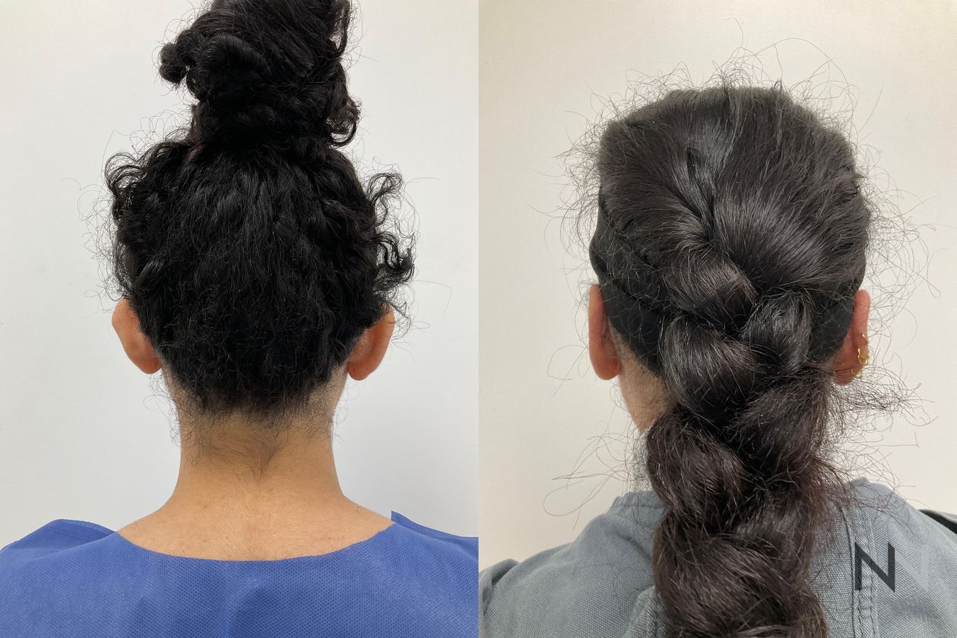 Ear positioning closer to head after otoplasty