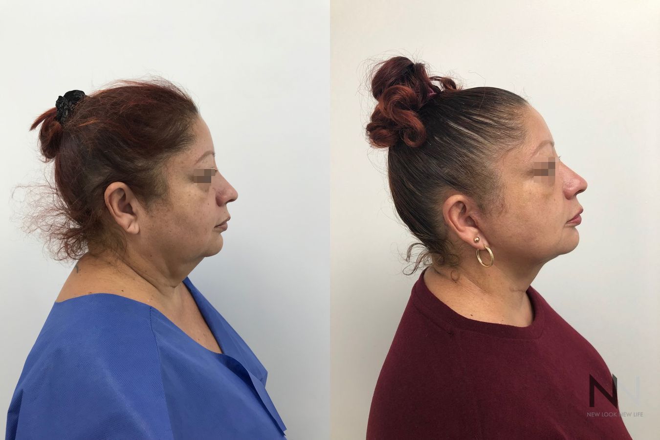 Before and after Halo Pro laser treatment skin resurfacing