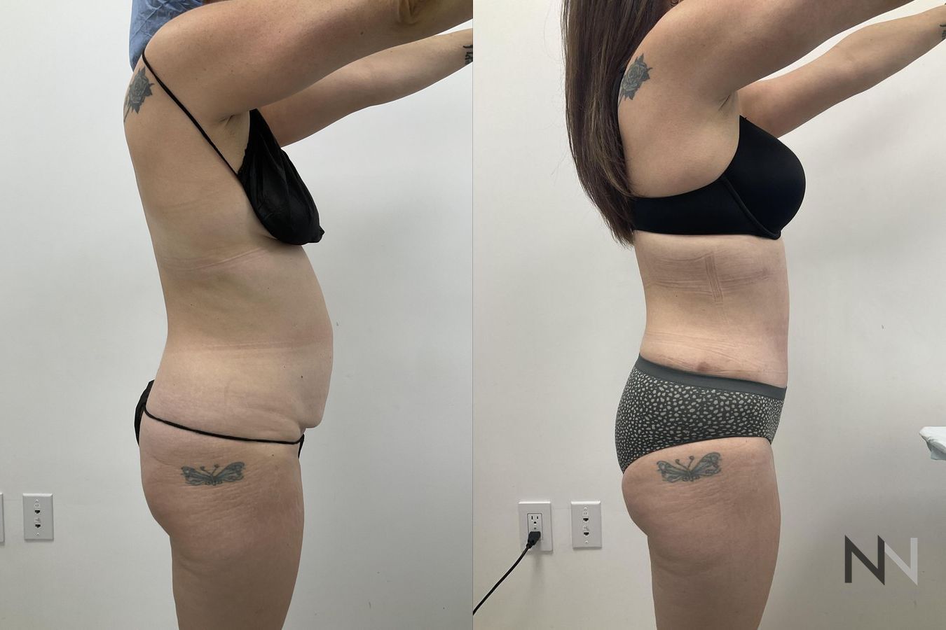 Waistline definition after abdominoplasty procedure - Angle 4