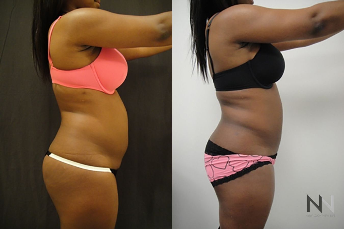 Liposuction 360 showing improved waistline definition - Angle 3
