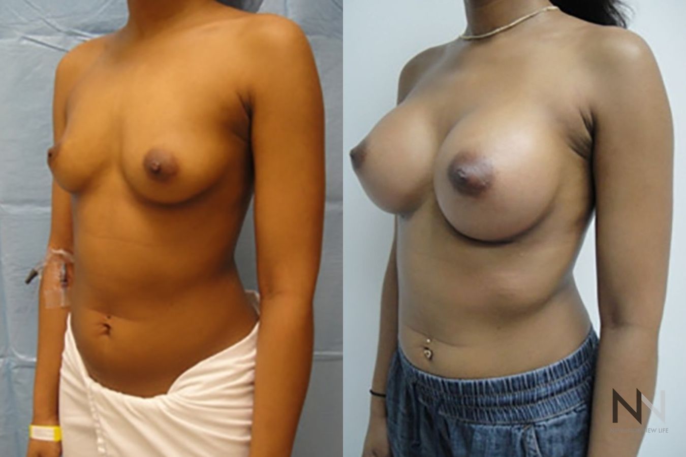 Breast implants showing increased volume and projection - Angle 2