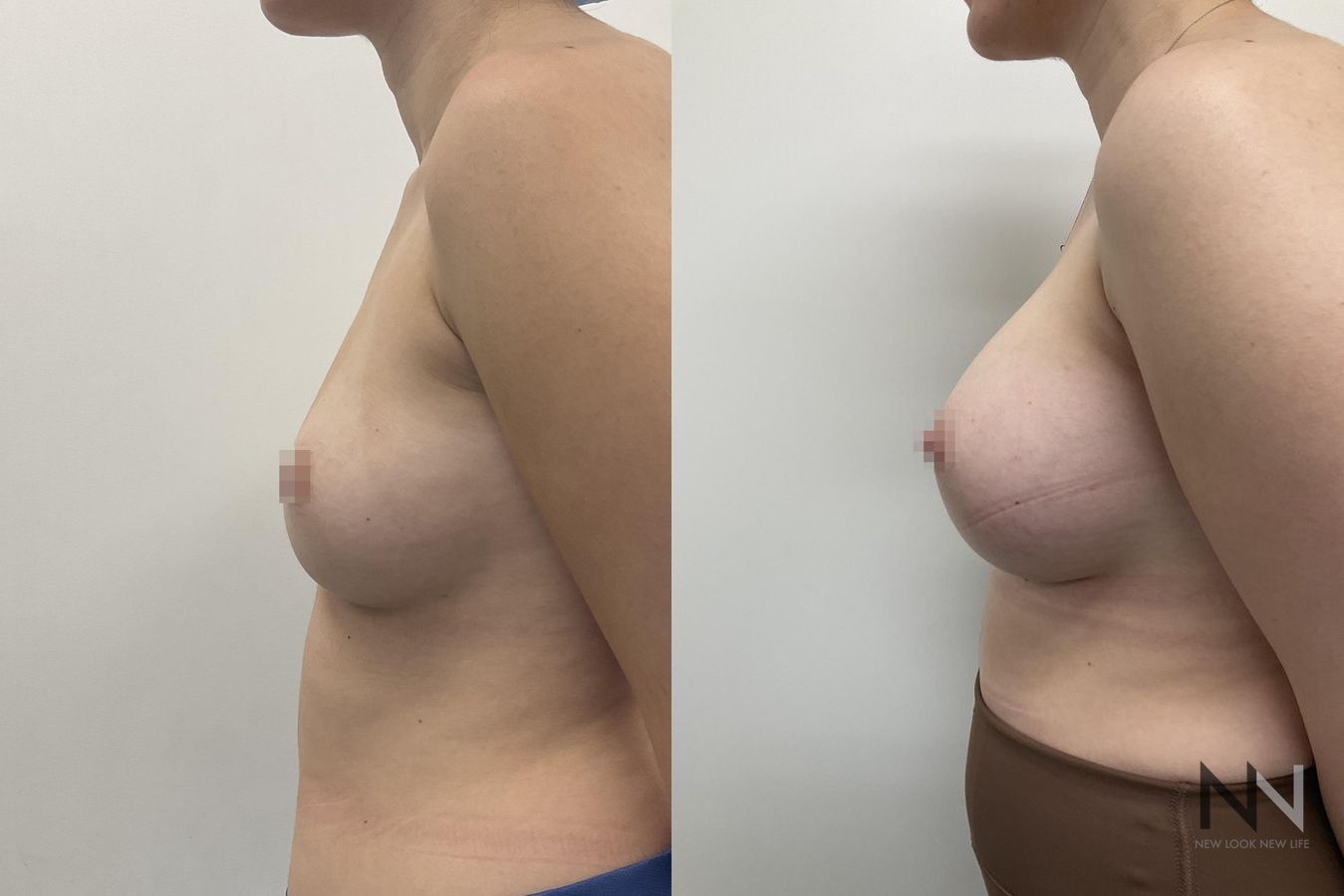 Before and after breast augmentation saline implants six months - Angle 3