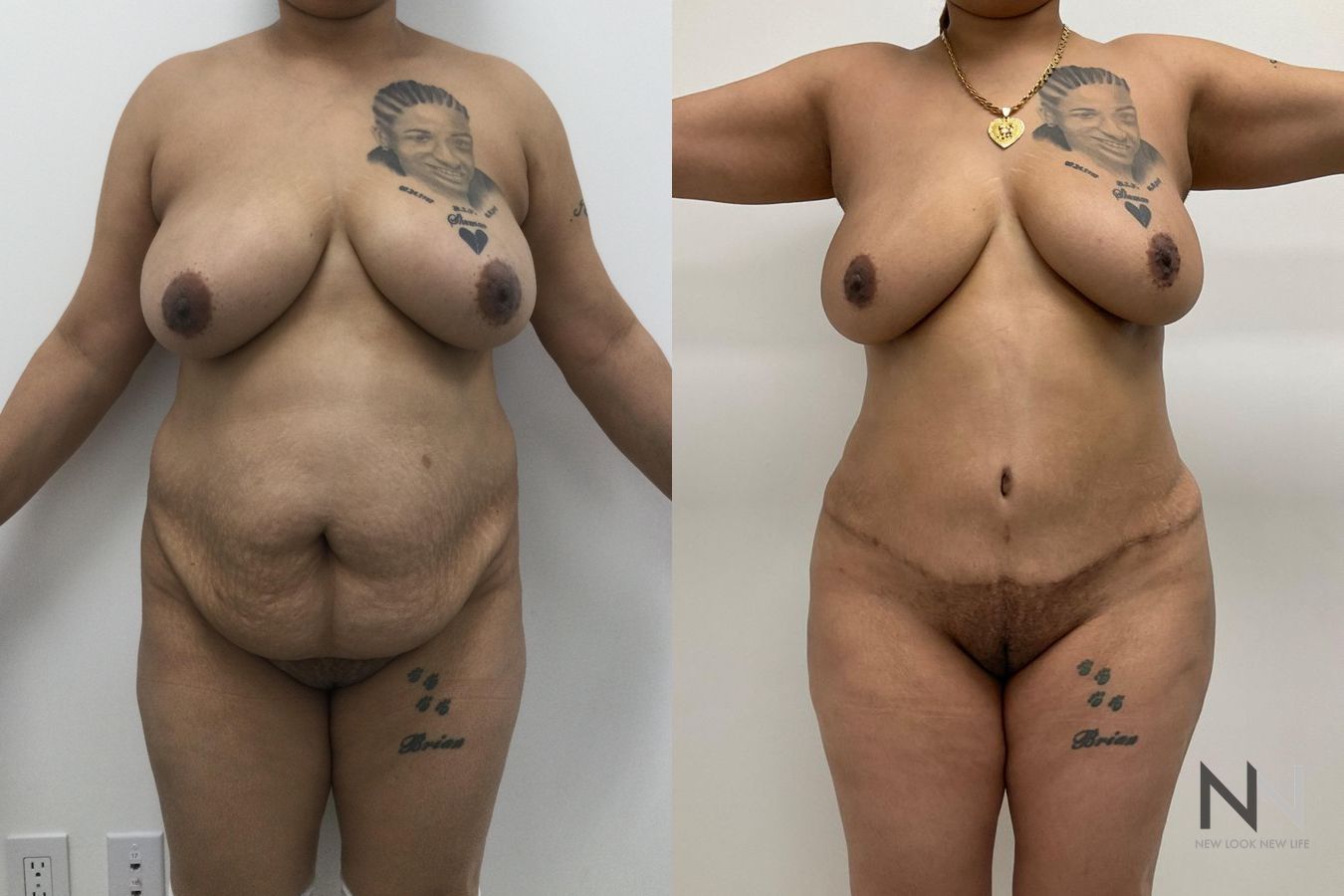 BBL showing increased buttock volume and contour - Angle 2