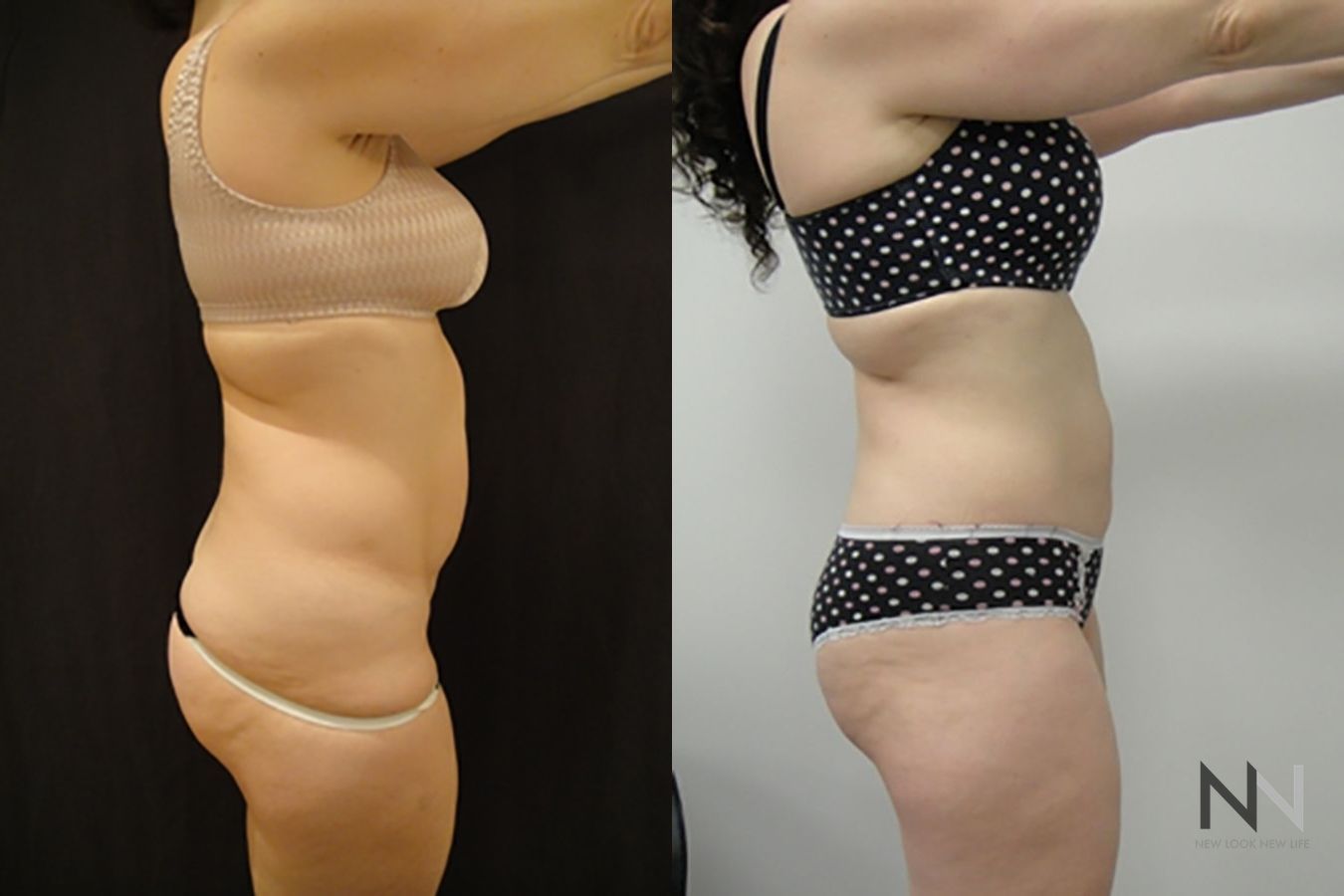 Before and after TICKLE liposuction flanks six months results - Angle 3