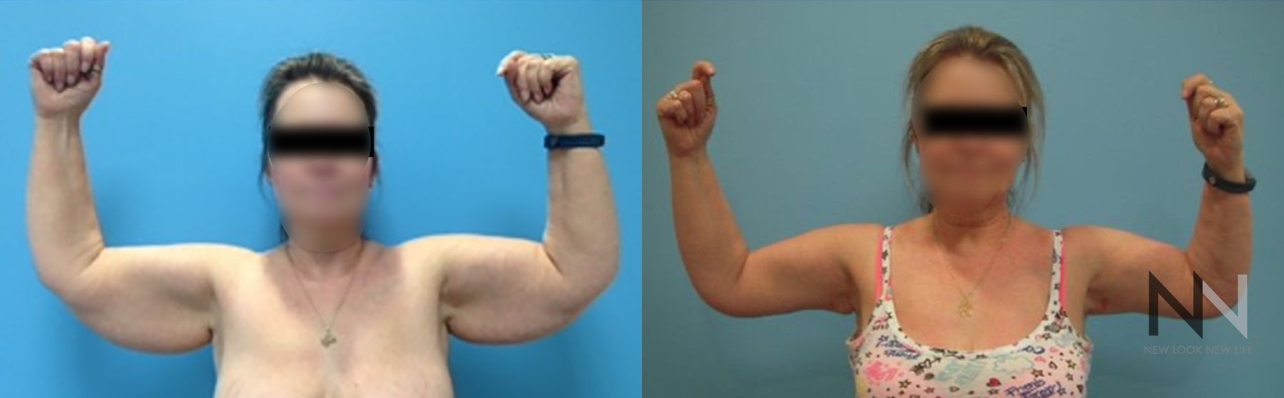 Upper arm tightening after brachioplasty surgery