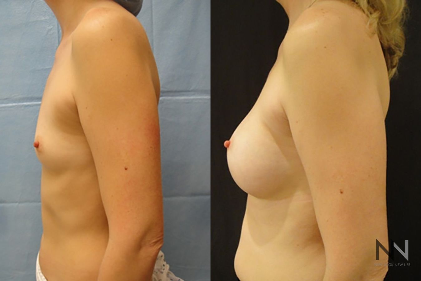 Breast augmentation before and after symmetry improvement - Angle 4