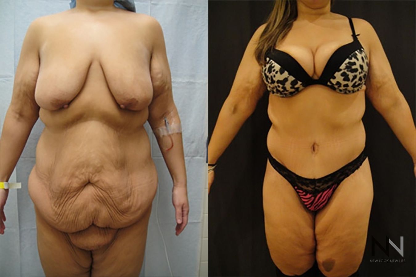 Abdominoplasty before and after showing flatter abdomen