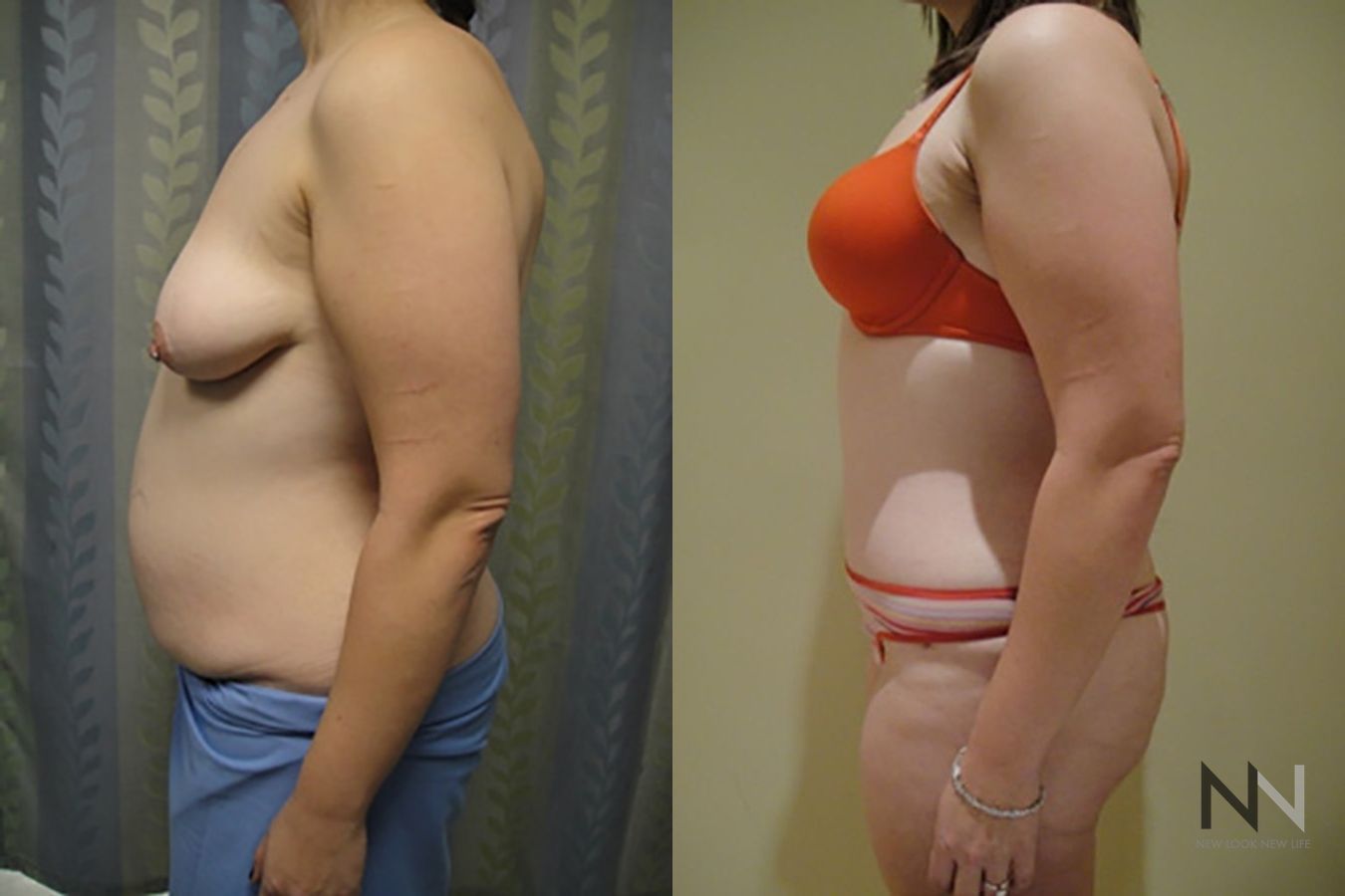 Before and after tummy tuck eight months results - Angle 2
