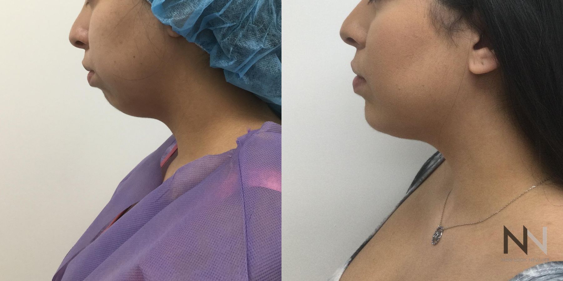 Chin augmentation before and after side profile comparison
