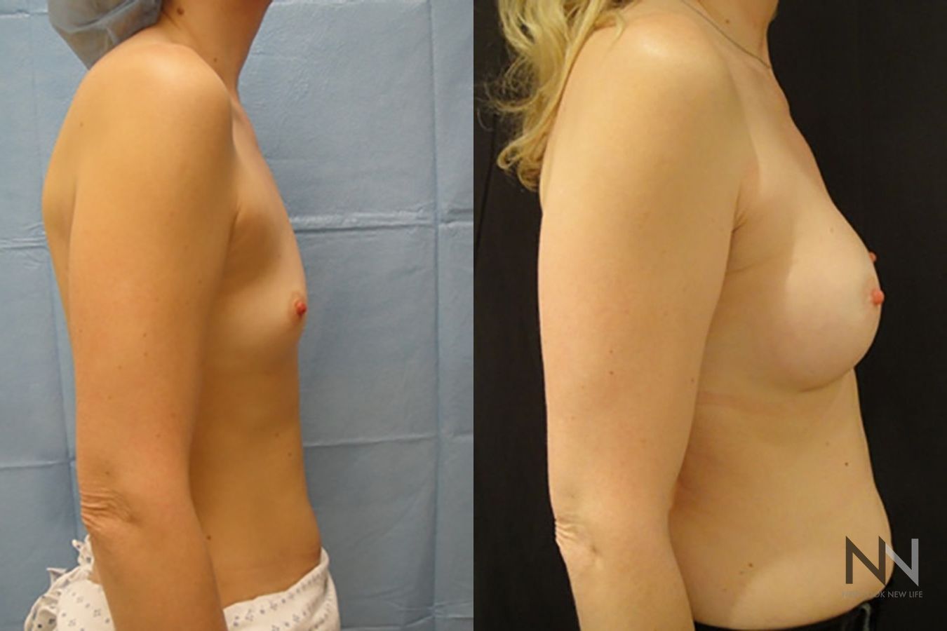 Breast augmentation before and after symmetry improvement - Angle 5
