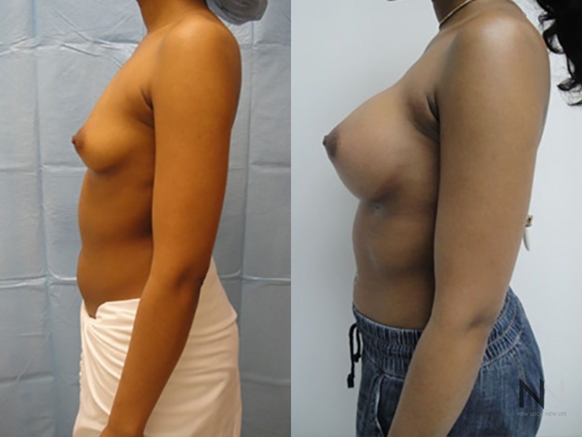 Breast implants showing increased volume and projection - Angle 3