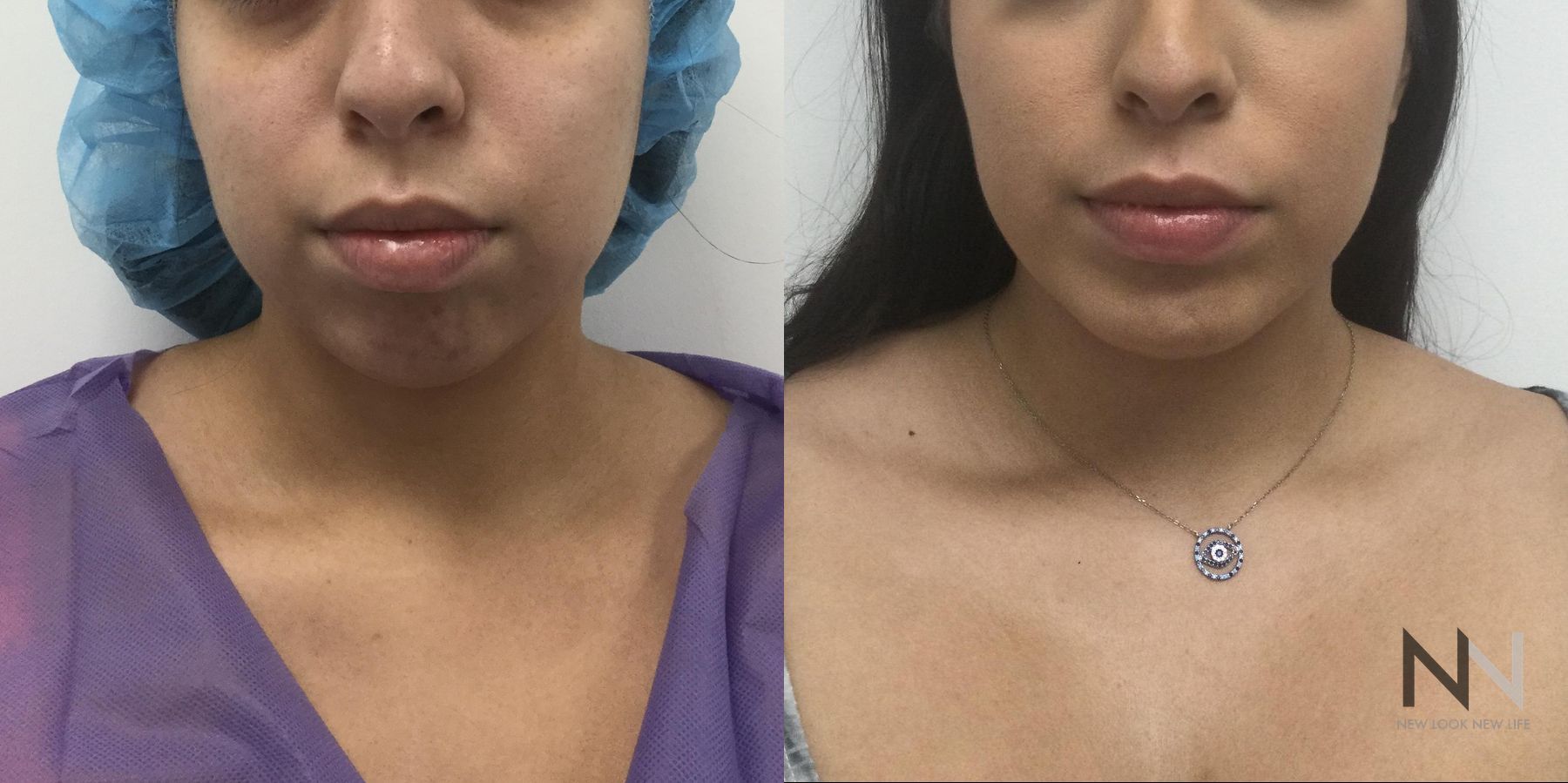 Chin augmentation before and after side profile comparison - Angle 3