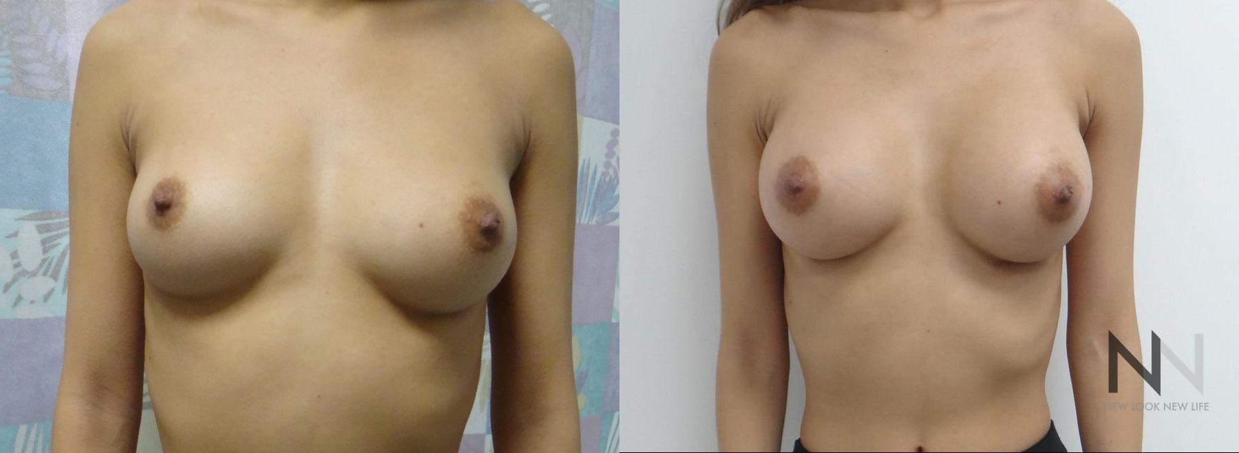 Before and after breast augmentation six months results