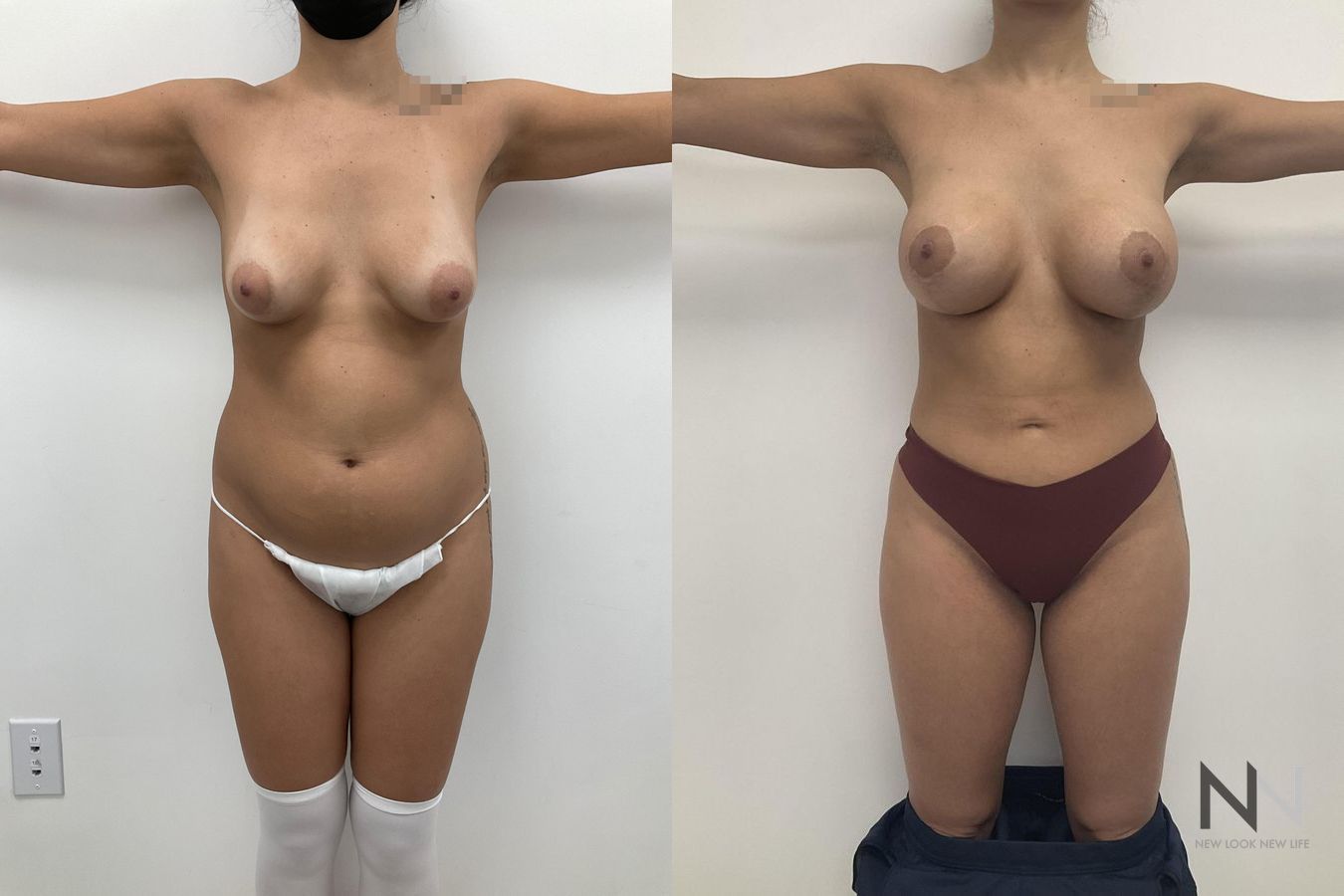 Before and after BBL and liposuction six months results - Angle 2