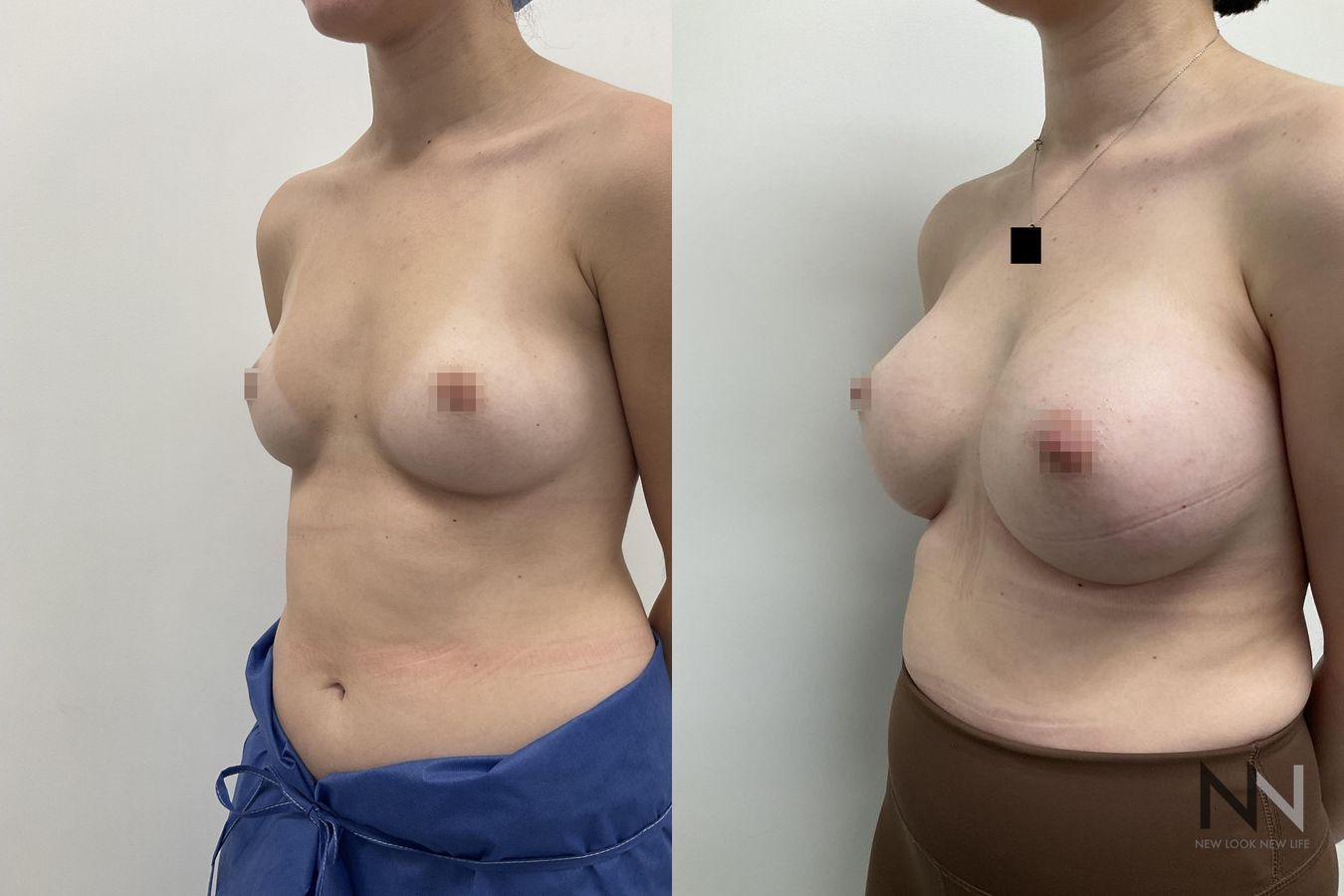 Before and after breast augmentation saline implants six months - Angle 2