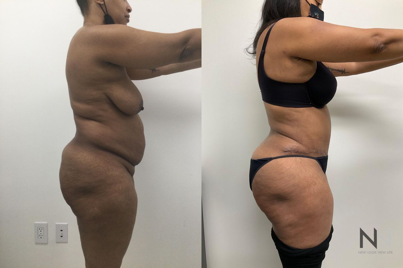 Liposuction 360 showing improved waist and flank contour - Angle 2