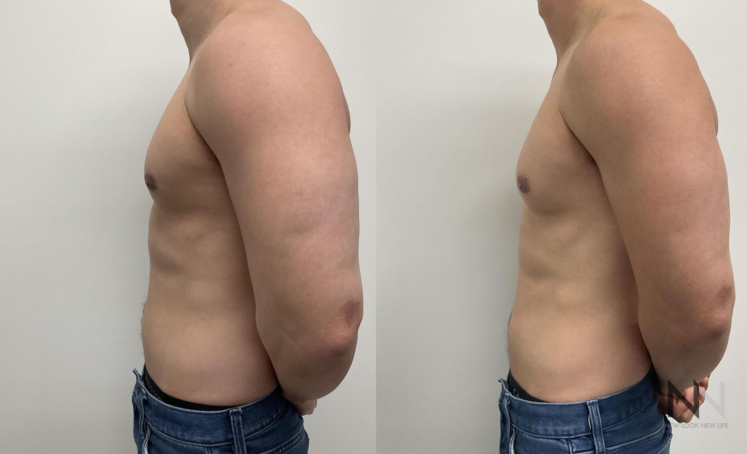 Gynecomastia surgery showing flatter chest contour - Angle 3