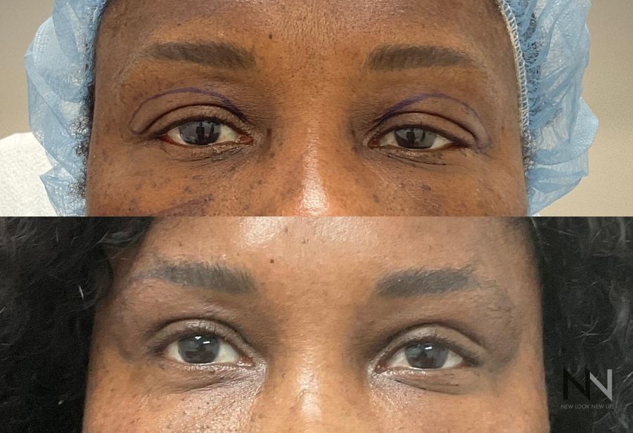 Upper blepharoplasty before and after eyelid contour improvement