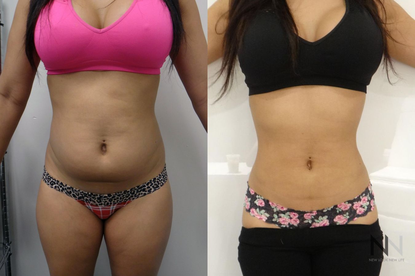 Awake liposuction showing improved waistline contour