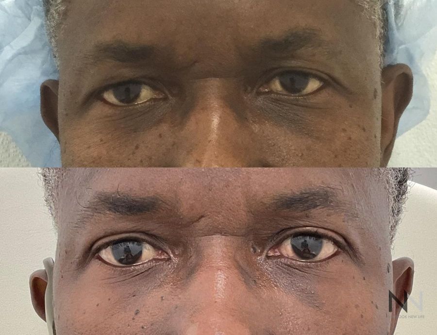 Before and after upper blepharoplasty three months results