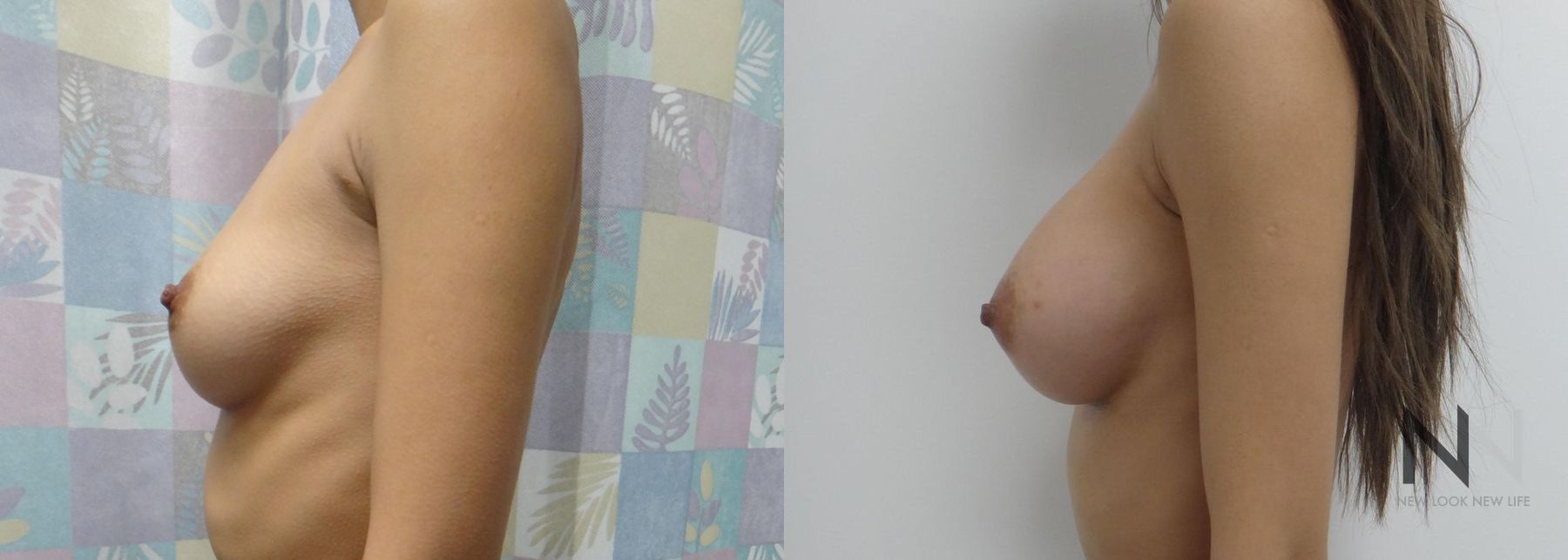 Before and after breast augmentation six months results - Angle 3