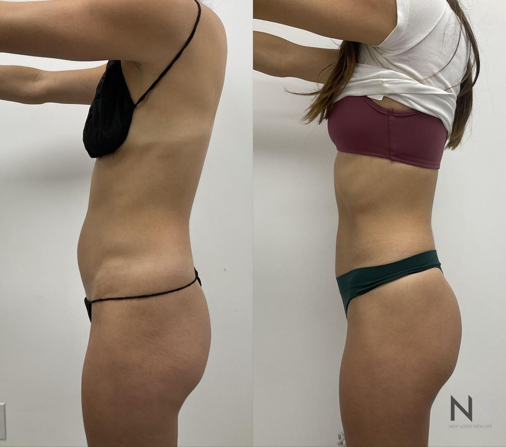 Liposuction of waist and abdomen showing improved contour - Angle 3