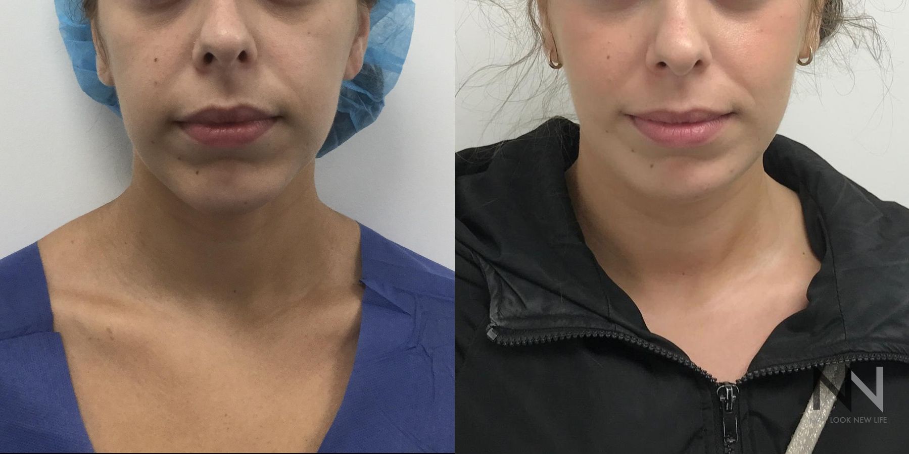 Before and after chin augmentation six months results - Angle 4