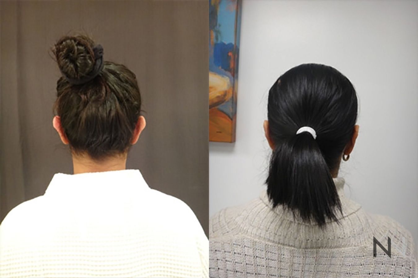 Before and after otoplasty three months results