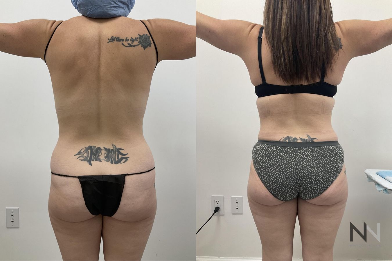 Waistline definition after abdominoplasty procedure - Angle 3