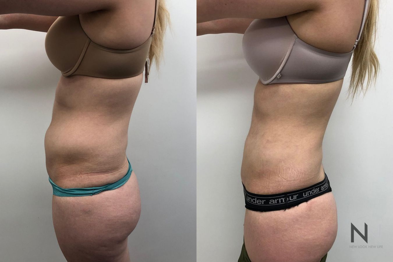 Awake liposuction abdomen and flank contour improvement - Angle 3