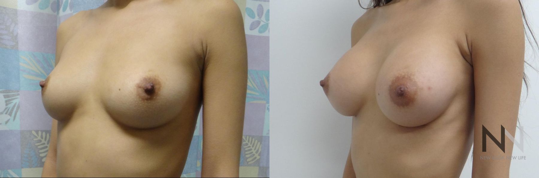 Before and after breast augmentation six months results - Angle 2