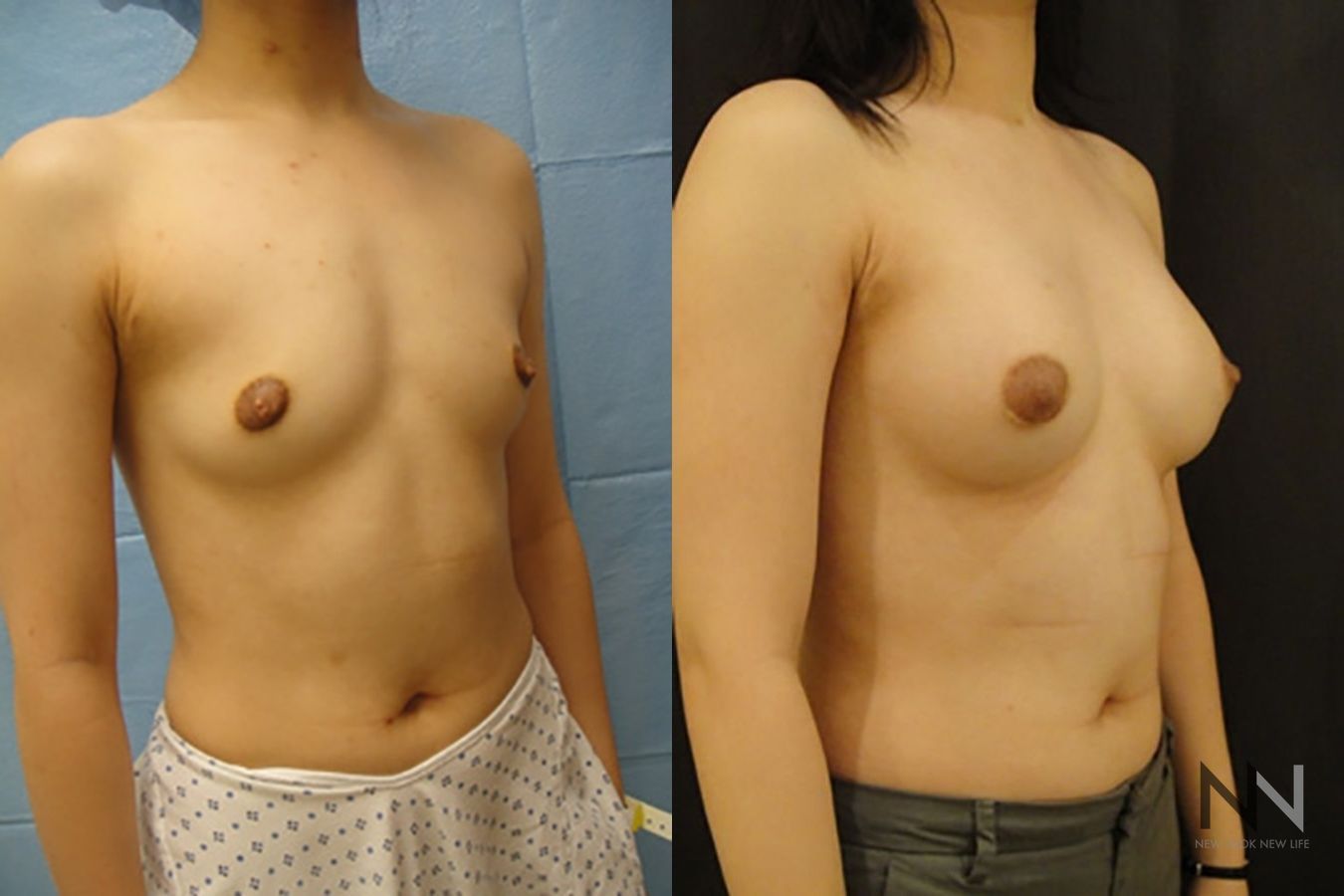 Breast augmentation results with improved projection - Angle 3