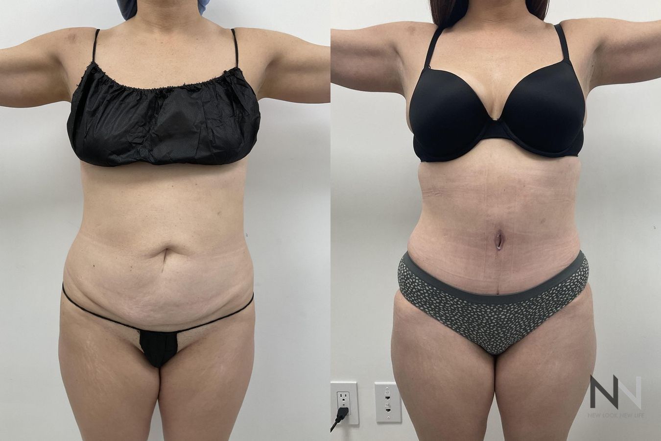 Waistline definition after abdominoplasty procedure