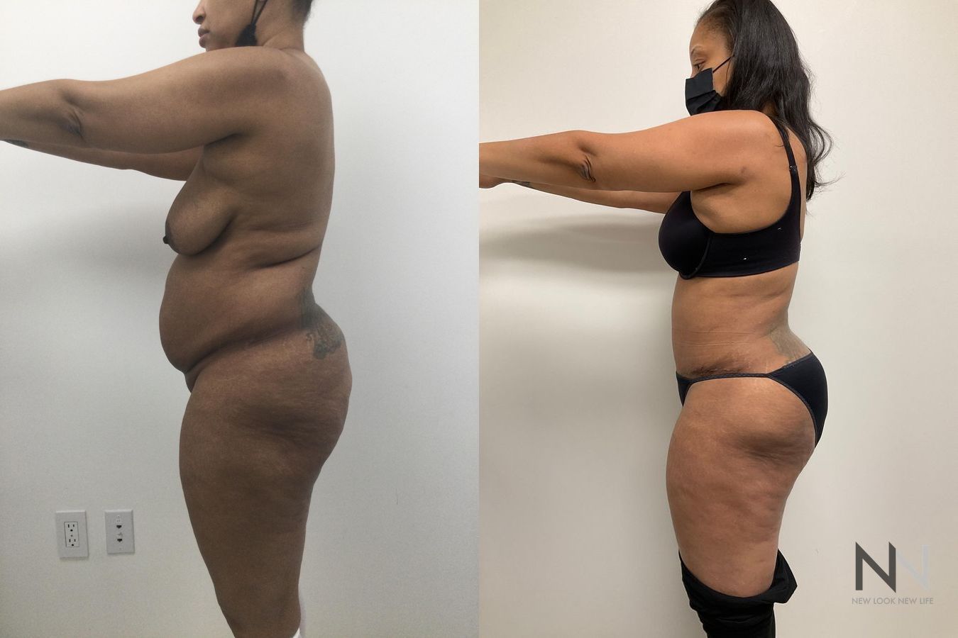 Liposuction 360 showing improved waist and flank contour - Angle 3