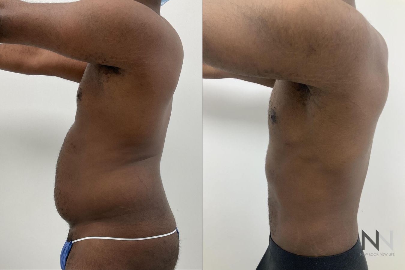 Body contouring with liposuction before and after - Angle 6