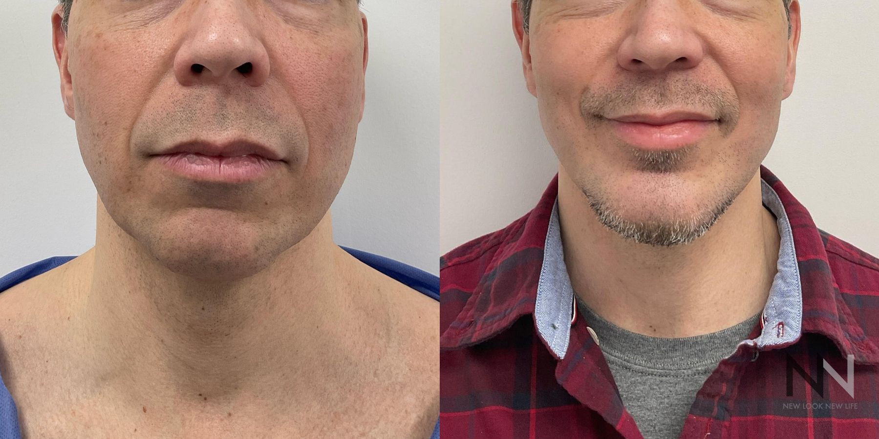 Jawline definition improvement after chin augmentation - Angle 3