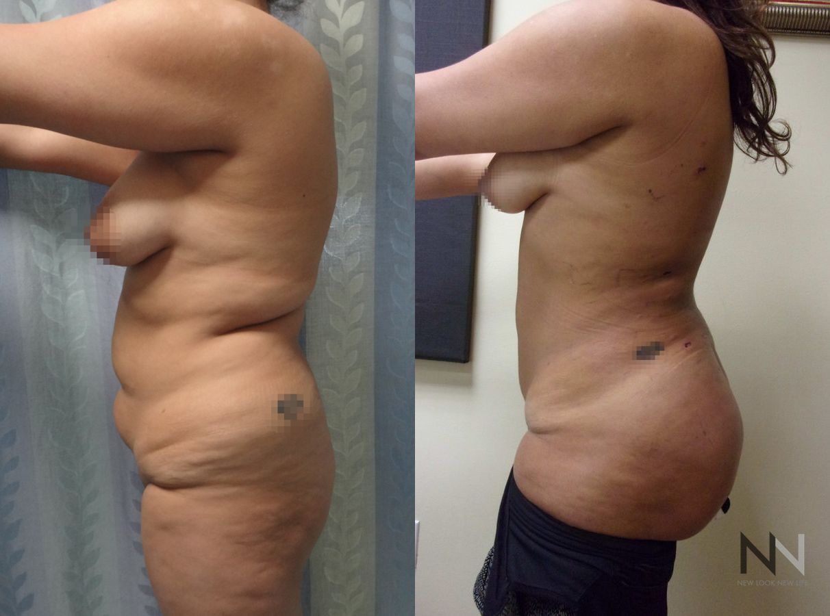 Liposuction of back and flanks with fat transfer to buttocks - Angle 2