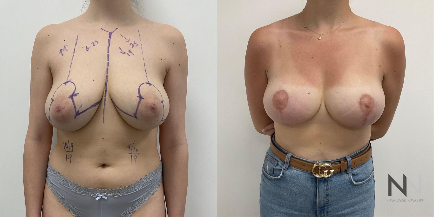 Reduction mammoplasty showing improved breast contour