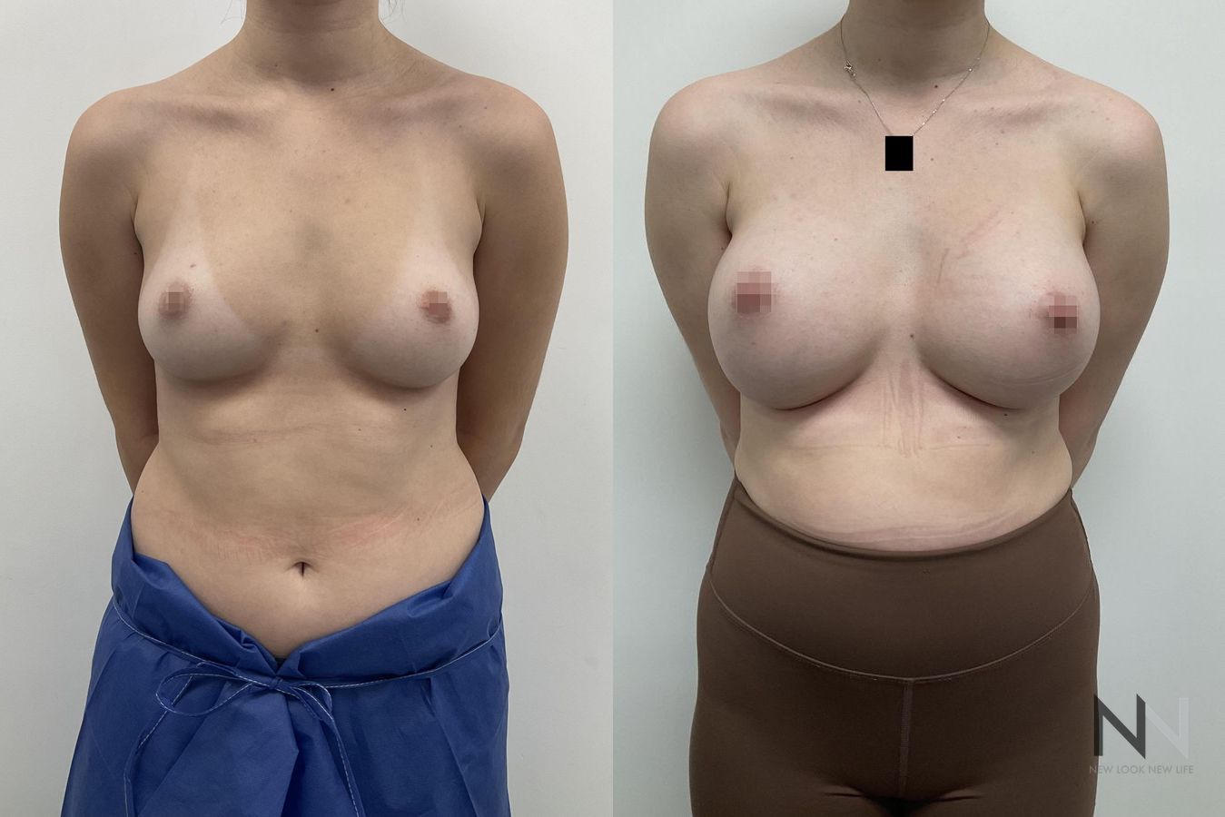 Before and after breast augmentation saline implants six months
